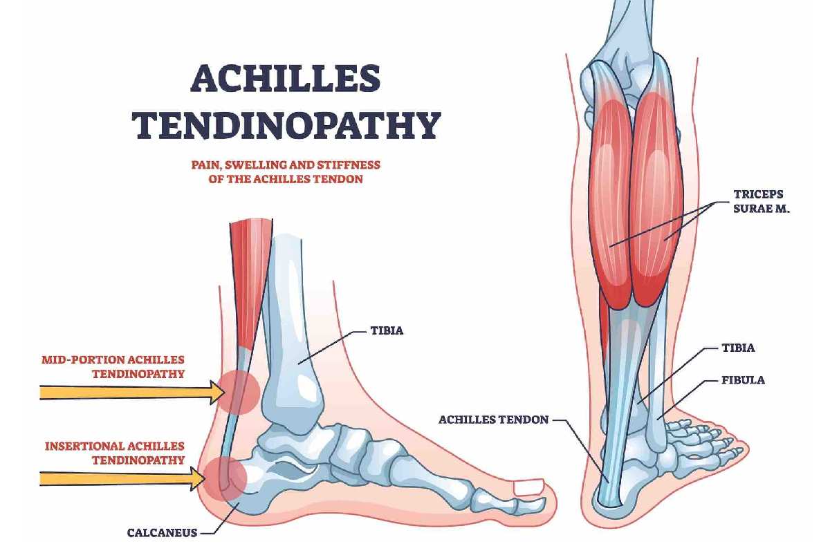 Understanding Achilles Tendinitis and When Surgery May Be Needed